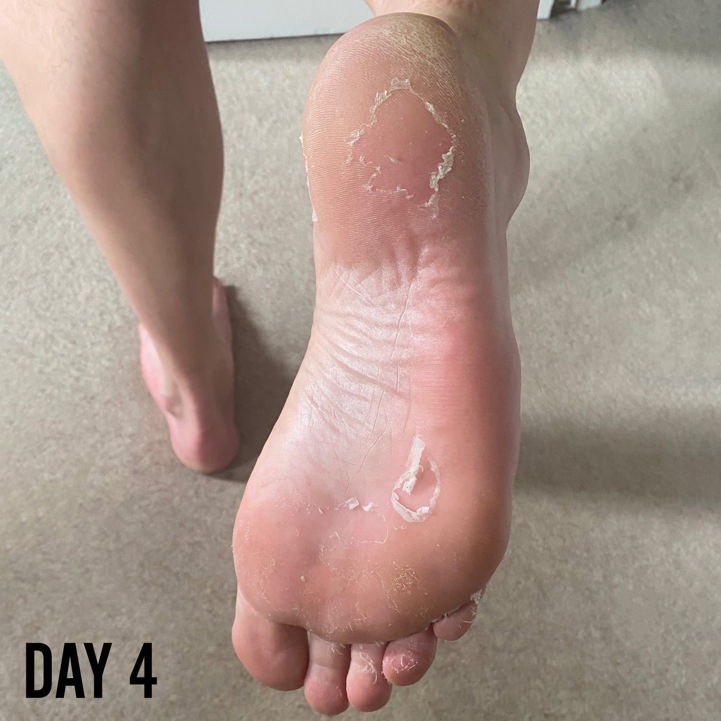 
                  
                    Barber Pro Foot Peel Day 4
                  
                