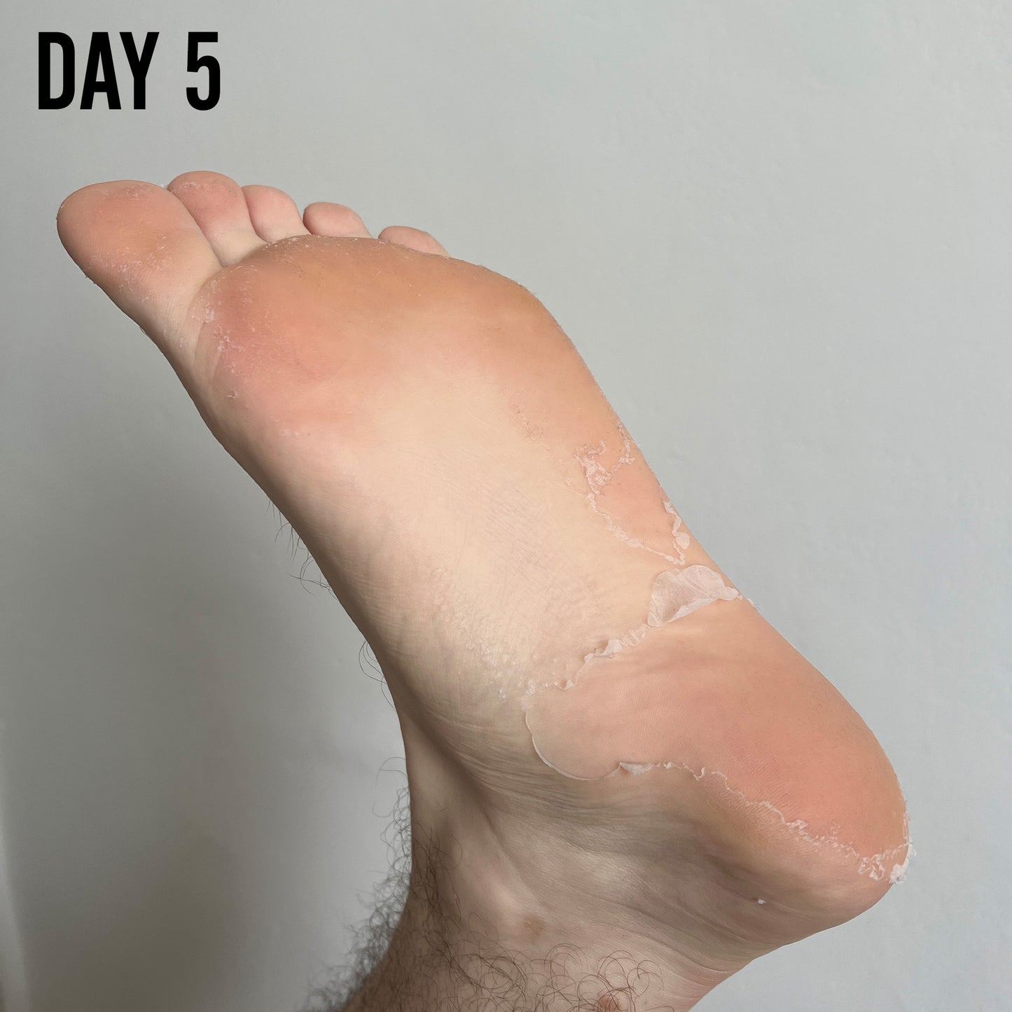 
                  
                    Barber Pro Foot Peel Day 5
                  
                